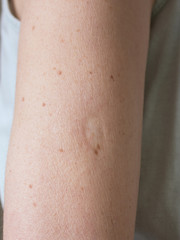 BCG vaccination mark on a woman's arm