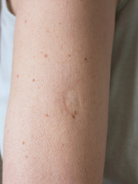 BCG vaccination mark on a woman's arm