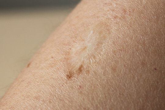 BCG vaccination mark on a woman's arm