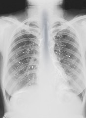 
Pulmonary X-ray and Virus Infection Symptoms Pulmonary damage in patients