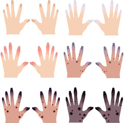 Sore hands. Skin diseases. Ulcers and rashes. Gangrene and necrosis. Stage of frostbite. Medical poster.