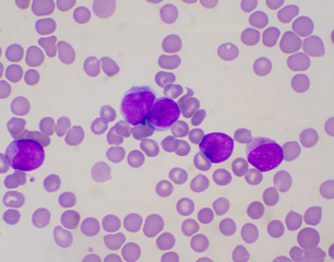 Fototapeta na wymiar Immature white blood cells in blood smear.