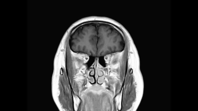  MRI Brain coronal t2 gradiente  view for detect stroke disease and covid-19.