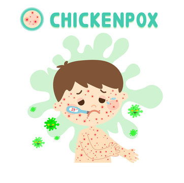Kids have Chickenpox and Virus Vector    
