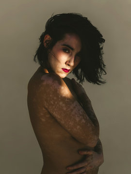 Vitiligo skin girl