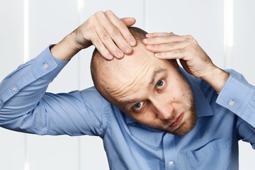 bald man looking at his balding head. Hair transplant concept. white sad caucasian guy