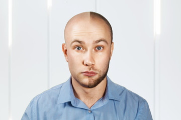 Portrait Man before and after hair loss, transplant. Split personality.