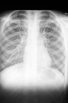 X-ray of the human chest