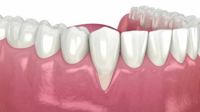 Gum Recession: Soft tissue graft surgery. 3D animation of Dental procedure 