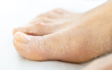 female foot with cracked dry skin, close-up on a white background