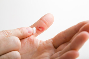 Young man hand applying medical ointment on thumb after burn. First aid. Self help. Medical...