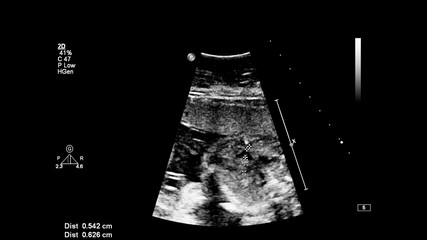 Ultrasound screen with fetal echocardiography