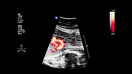 Ultrasound screen with fetal echocardiography