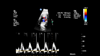 Ultrasound screen with fetal echocardiography