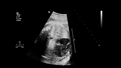 Ultrasound screen with fetal echocardiography