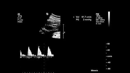 Obraz premium Ultrasound screen with fetal echocardiography