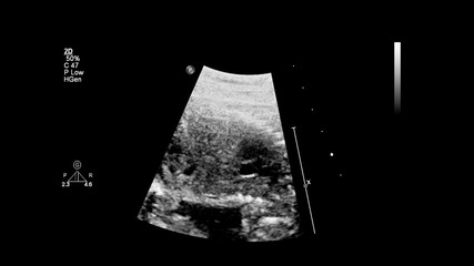 Ultrasound screen with fetal echocardiography