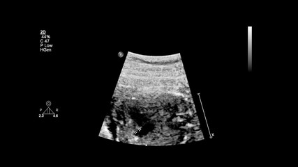 Ultrasound screen with fetal echocardiography