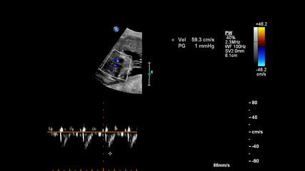 Fototapeta na wymiar Ultrasound screen with fetal echocardiography