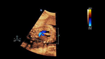 Ultrasound screen with fetal echocardiography