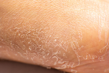 dry cracked damaged human skin surface
