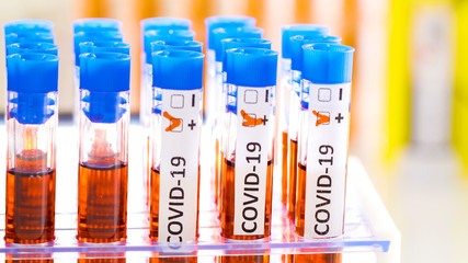 28105_The_coronavirus_positive_sample_on_the_table.jpg