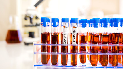 A lab doctor marking the test tube with positive for coronavirus