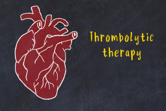 Chalk Sketch Of Human Heart On Black Desc And Inscription Thrombolytic Therapy