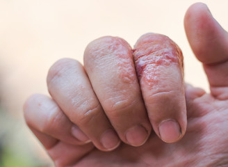 Allergy symptom rash and blister on finger right hand asian woman