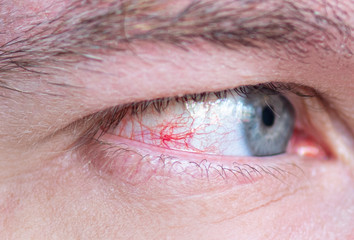 Close-up eye with red bloodshot capillary and veins