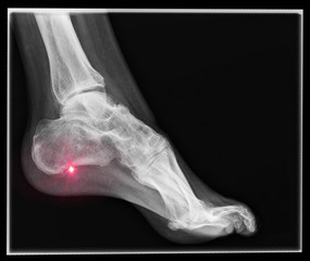 Röntgen Fuß mit Fersenspor als Diagnose