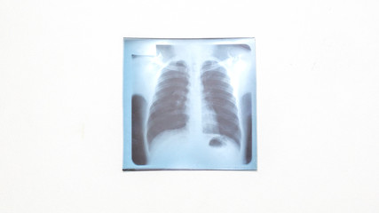 Lung x-ray film on white background
