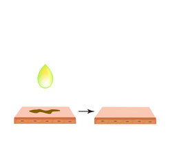 Pigmentation on the skin. Brown spots on the skin. Pigmentation treatment. Infographics. Vector illustration on isolated background.