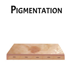 Pigmentation on the skin. Brown spots on the skin. Pigmentation treatment. Infographics. Vector illustration on isolated background.