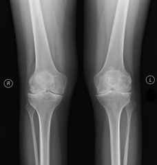 Real skeleton x-ray of woman knee suffering from rheumatism. Rheumatoid arthritis knee pain medical...