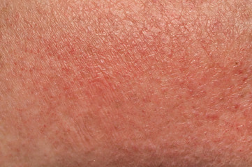 Skin manifestations of an allergic reaction to the sun close up. Soft focus, shallow depth of field.