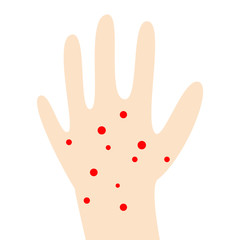 Red spots on the child hand of light skin. Concept of skin diseases, vector stock illustration
