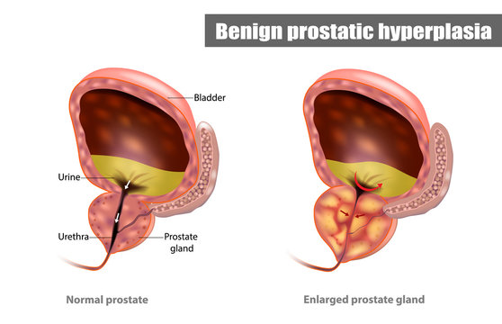 Prostate Equity Hyperplasia)