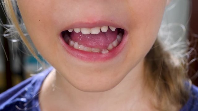 Little girl with wobbly first milk temporary tooth. Dental medicine or mouth healthcare concept