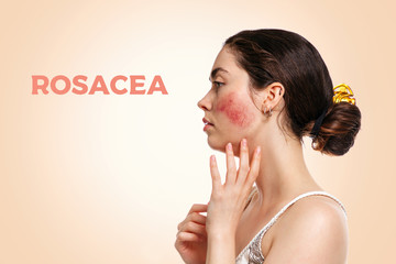 Portrait of a young beautiful Caucasian woman with reddened and inflamed blood vessels on her...