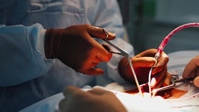 Neurosurgeons are performing operation in medical clinic. Hands of surgeon and a nurse using medical tools. Blood flow in tubes during surgery. Close-up.