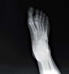 normal x-ray of the foot bones