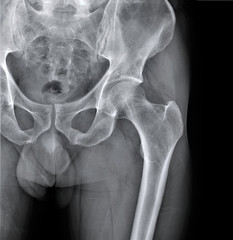 x-rays of the hip joint