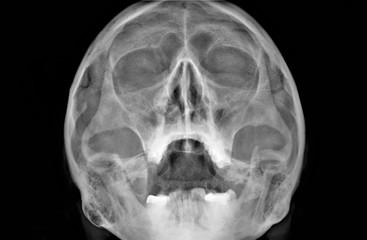 x-ray of the paranasal sinuses of the facial skull