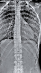 normal chest x-ray, diagnosis of pneumonia