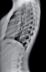 x-ray of the thoracic and lumbar spine in a lateral projection