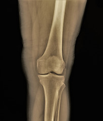 normal x-ray of the knee joint