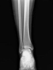 x-ray of the ankle joint, diagnosis of fractures