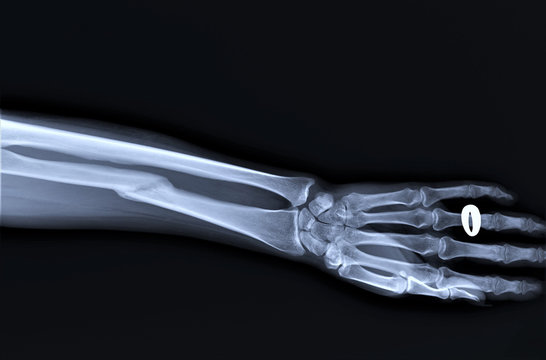 x-ray of the forearm bones with an incorrectly fused radius fracture