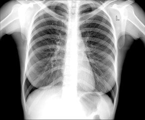 Chest x-ray, pneumonia prophylaxis